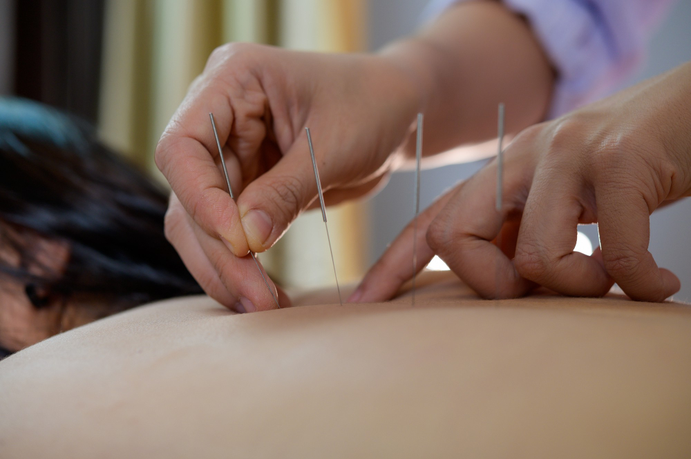 acupuncture in Edmonton